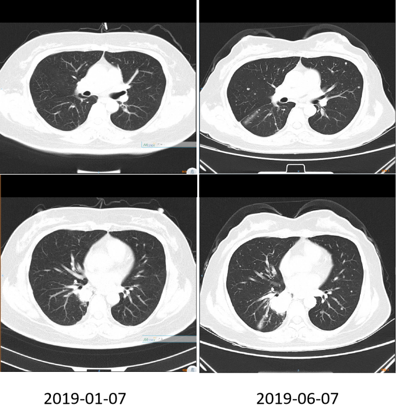 二线治疗期间胸部影像学改变.png
