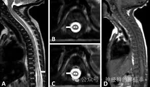Owl's eyes” sign in acute spinal cord infarction in newborn submitted to  aortoplasty