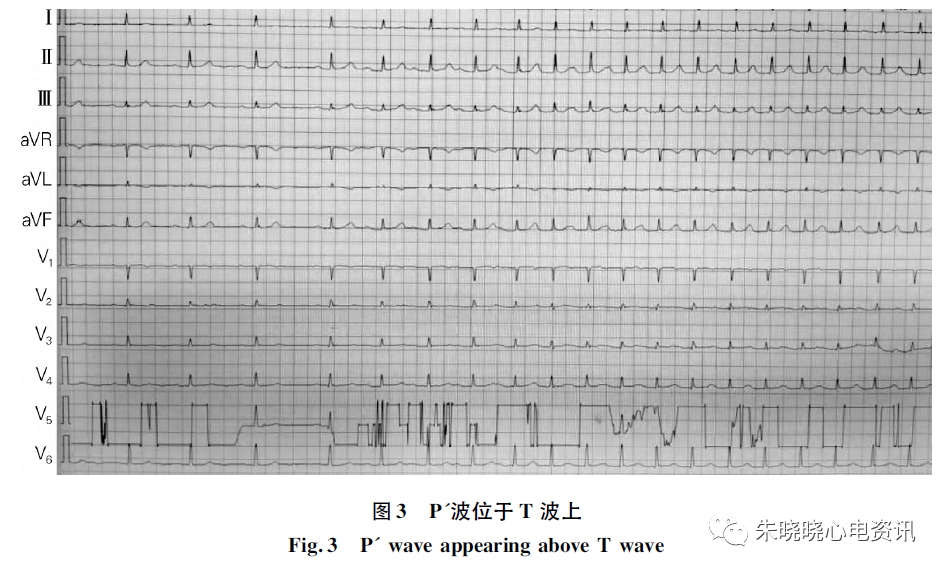 p波高尖心电图诊断图片