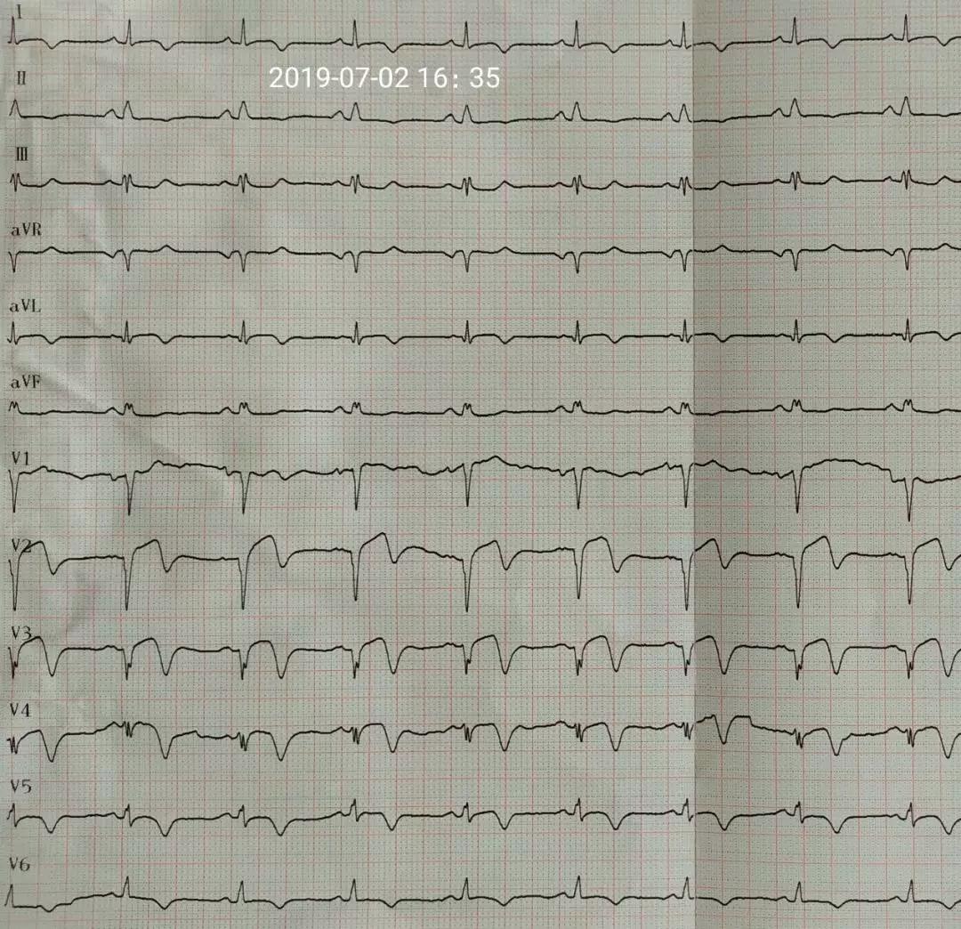 35心肌梗死梗後第10天,心電圖示竇性心律,v1~v3導聯形成病理性q波,v4