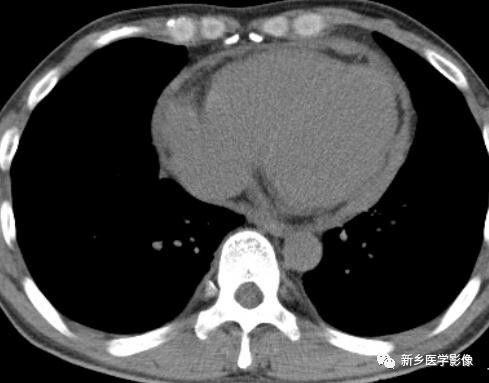 心包脂肪垫ct图片