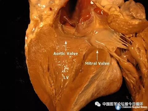 半月瓣是主动脉瓣吗图片