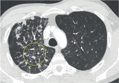 D14 中国医学论坛报血液病分枝杆菌感染（初稿）-张樱.png