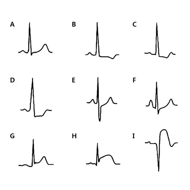 急性心梗心電圖,各階段特點彙總分析