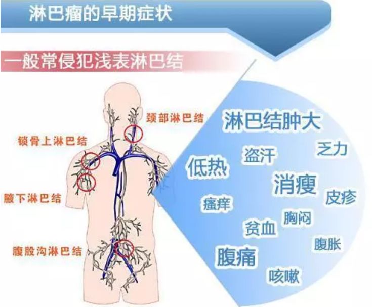 在臨床上,淋巴瘤的首發症狀多為淺表淋巴結腫大,且超過50%的