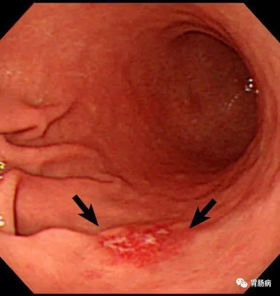胃癌发生部位的胃黏膜会发生改变,表现为隆起或者凹陷,有时有溃疡形成