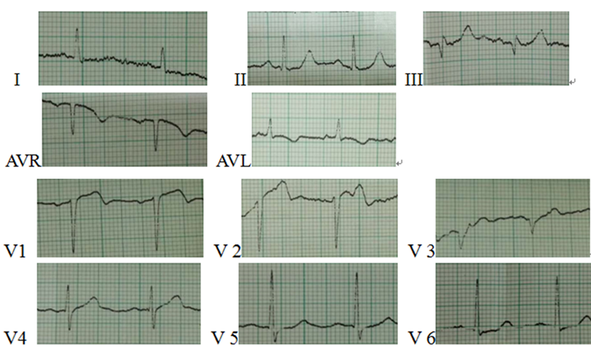 主动脉瓣狭窄心电图图片