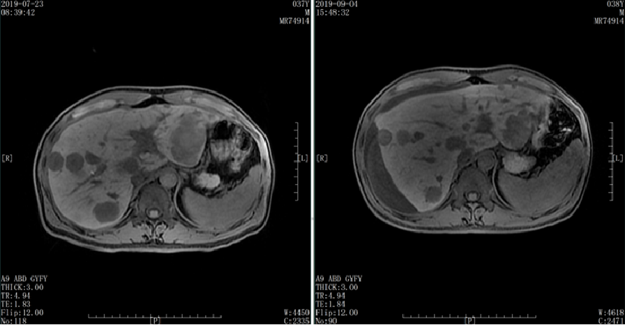 2019-09-04複查腹部mr(右側)示:與7-23 mr片(左側)對比,肝內多發轉移