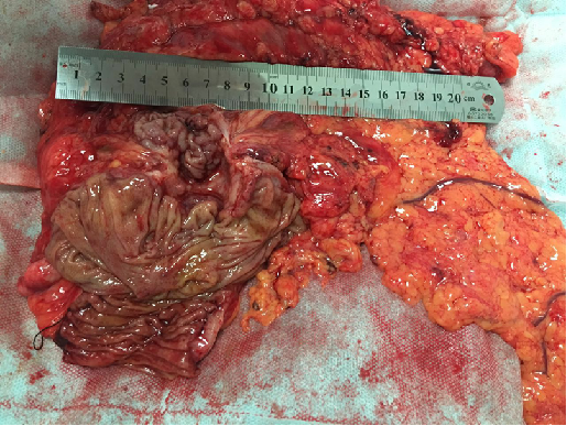 万例鉴肠程右半结肠癌伴肝肺转移一例清华大学第一附属医院赵力