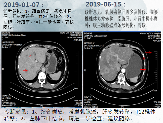 激素受體陽性晚期乳腺癌病例——蕪湖市中醫醫院,陳彥