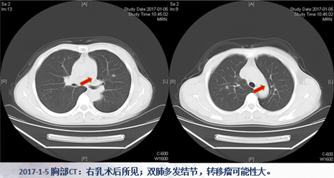 乳腺癌ct片图片图片