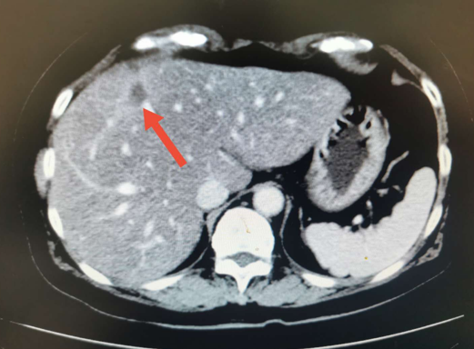 腹部ct:肝s8可見片狀相對高密度灶,大小分別為1.7cm×1.1cm,1.6cm×1.