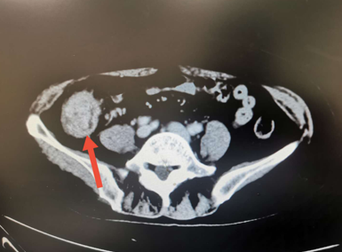 回盲部占位,考虑结肠癌(ct3n2m1),累及回盲瓣及近端小肠;腹部ct(2016