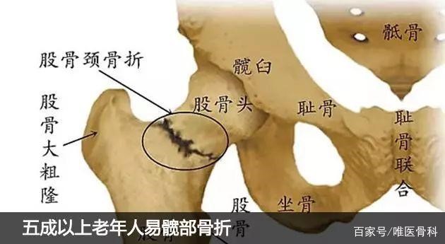 壹生资讯 为什么说老年髋部骨折是 人生最后一次骨折