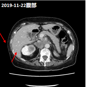 2020-01出現血壓控制不佳(160-170/90-105mmhg),患者在既往