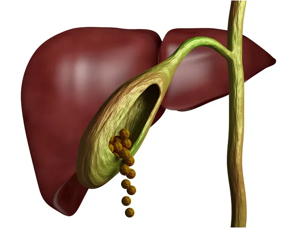 有症狀的膽結石和無症狀膽結石究竟是怎麼回事?