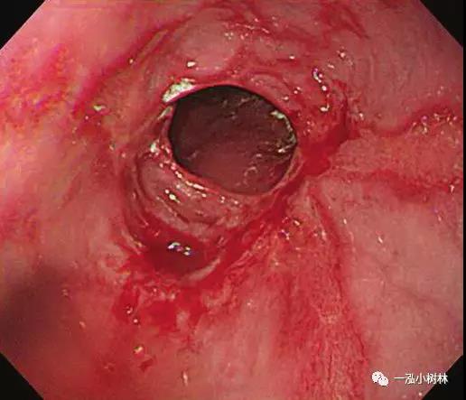 反流性食管炎胃镜图片