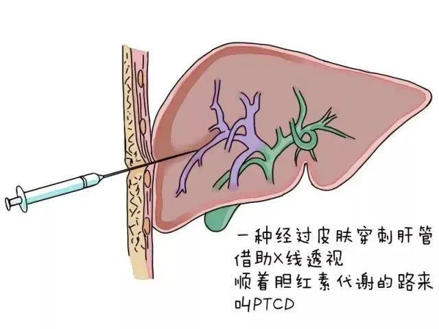 ptcd原理图片