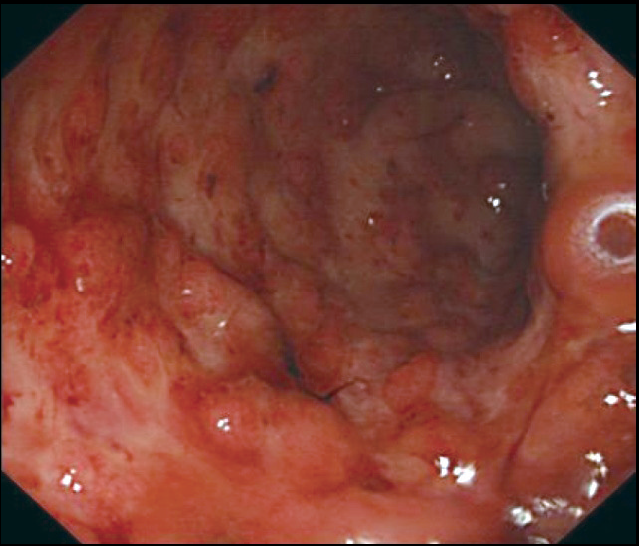 图4 直肠黏膜充血,糜烂,有自发出血治疗措施静脉应用琥珀酸氢化可的松
