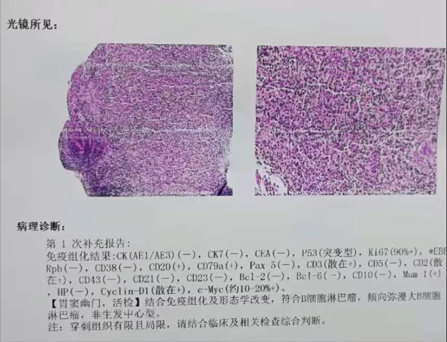 重新胃鏡檢查,要求一定要多點取材,儘量深挖,並做免疫組化檢查