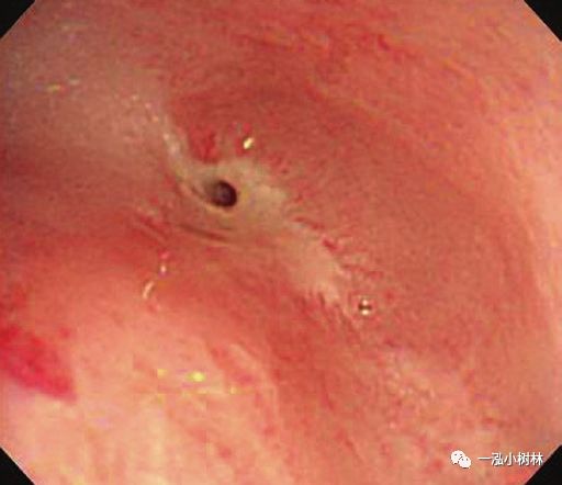 紫蔻丸反流性食管炎图片