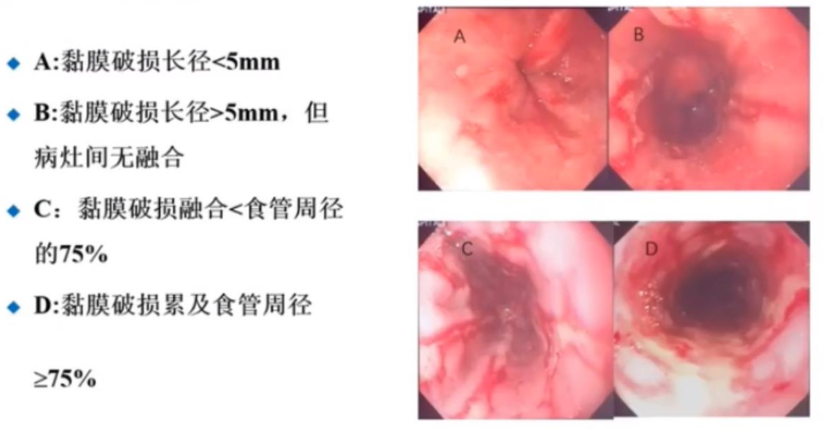 洛杉矶分型.png