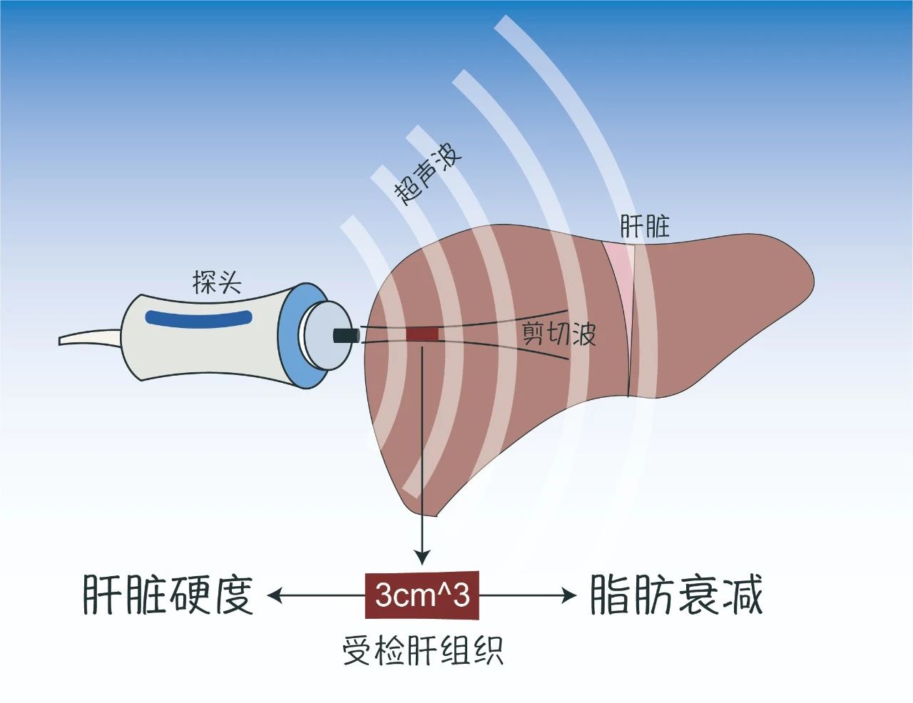 探头上的超声换能器发射超声波追踪剪切波并测量其速度,肝脏硬度越大