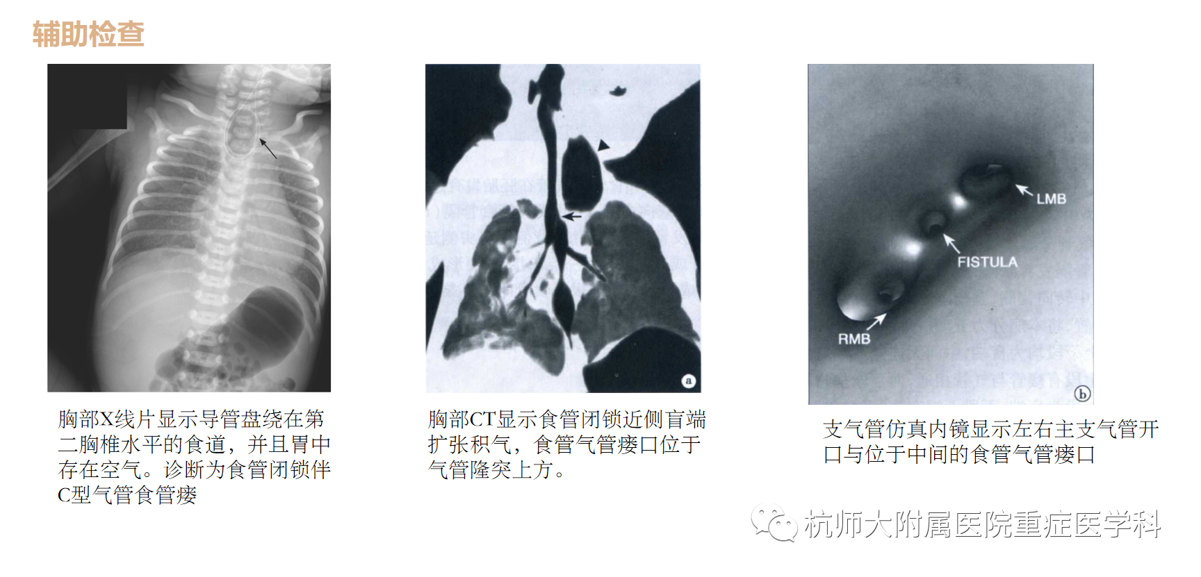 先天性食管闭锁的胸腔镜治疗（微创） - 微医（挂号网）