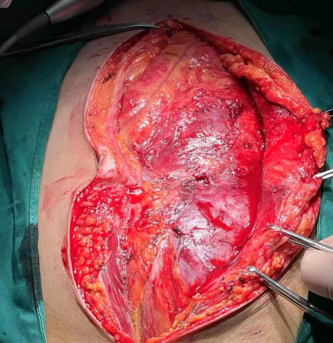 子宫肌瘤刀口位置图片图片