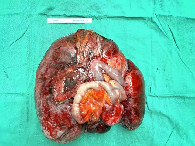 清华长庚病例分享腹腔内巨大硬纤维瘤1例