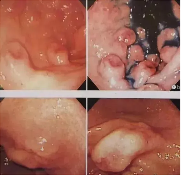 疣状胃炎手术图片