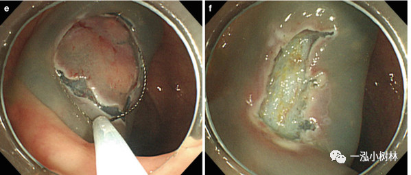 肠息肉切除过程图图片