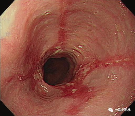 反流性食管炎barretts食管及腺癌的内镜表现