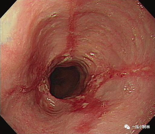 反流性食管炎胃镜图片