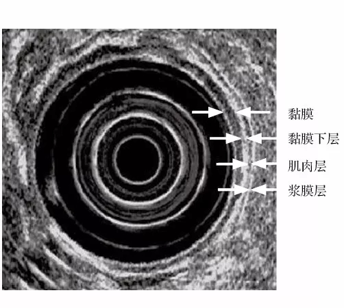 胃壁5层分层超声图片图片