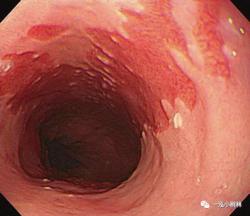 反流性食管炎胃镜图片
