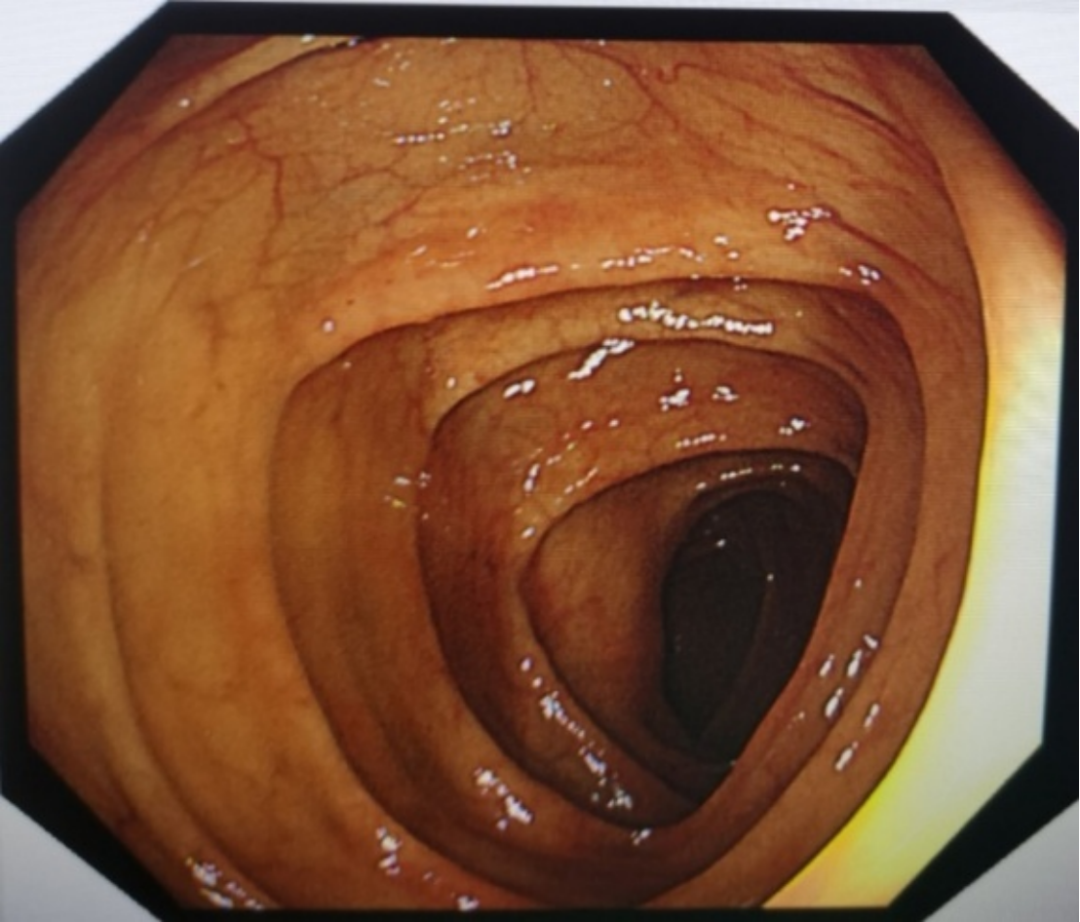 肠镜什么样子的图片图片