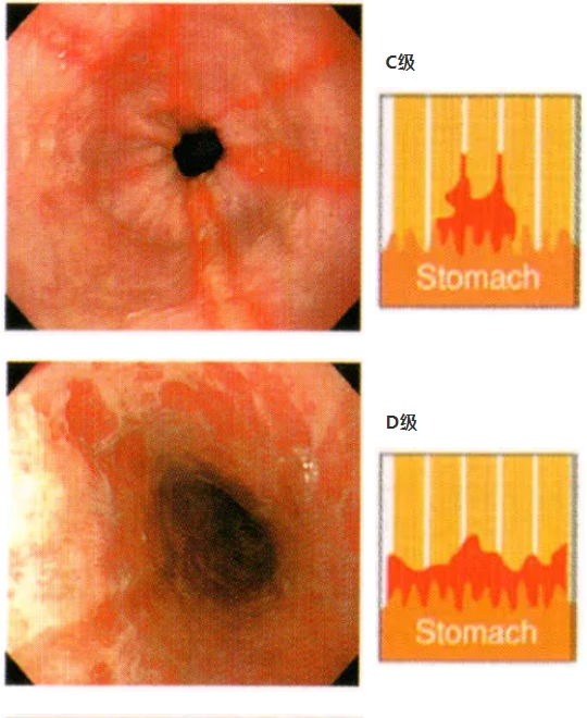 反流性食管炎胃镜图片