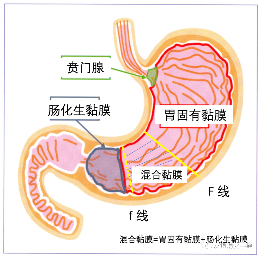壹生资讯-胃癌三角理论：从病理学看胃癌的诊断