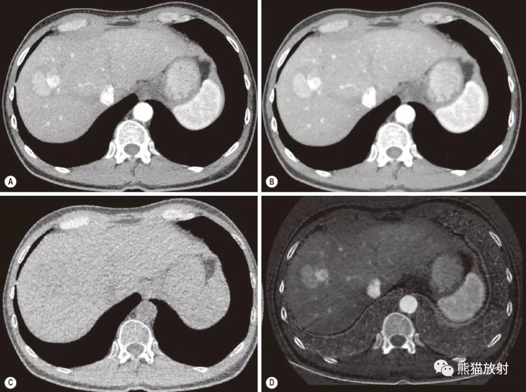 肝細胞癌的雙能量ct圖像