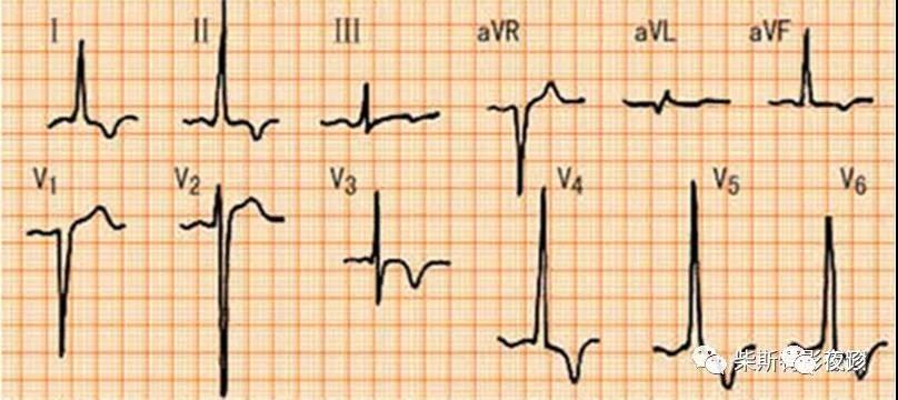 1mv) ④ 心绞痛缓解后出现t波对称性深倒置或正负双向,以后逐渐转为