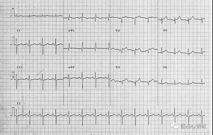 图4,亚急性心电图4,陈旧期此期通常出现在急性心肌梗死数月之后,st段