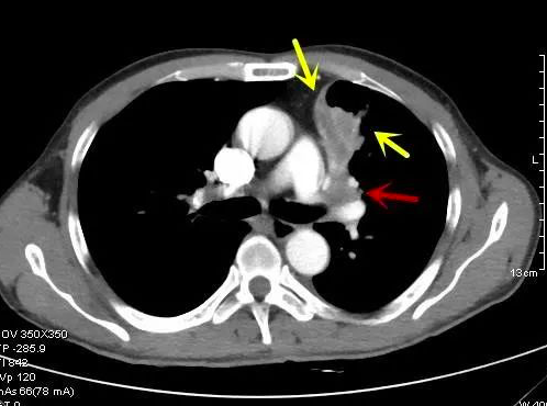各种类型肺癌典型表现