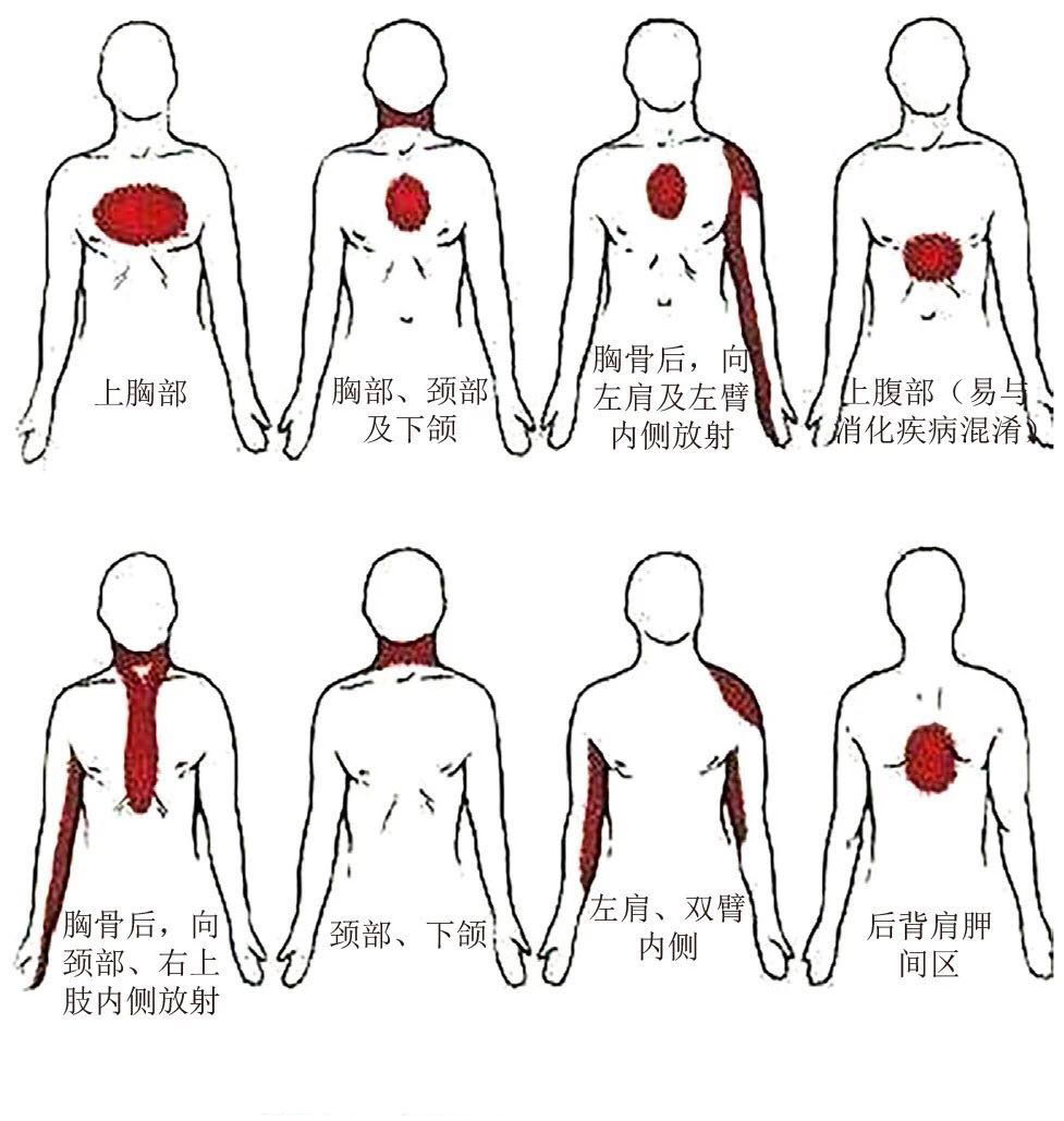 典型胸痛部位.jpg