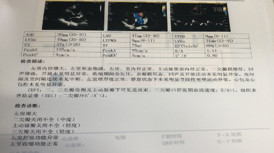 肝颈静脉回流征阳性图片