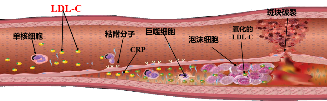 crp:c反應蛋白ldl-c:低密度脂蛋白膽固醇ascvd發病危險的評估acs急性