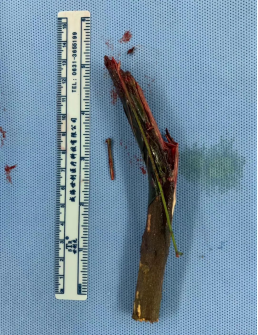 男子被14厘米树枝折弯穿颈而入 广西医科大学第一附属医院多学科团队接力成功救治-广西医大一院218.png