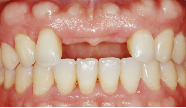 【临床实例】上牙列缺损伴慢性牙周炎牙齿移位一例