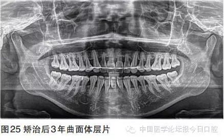 【临床实例】牙周病正畸