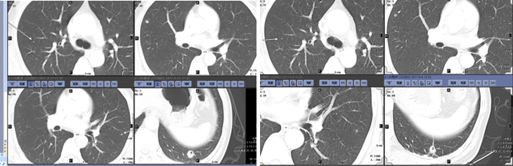 同步放化疗前后肺部病灶.png